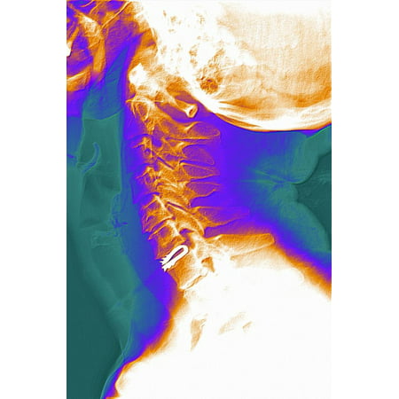 Artificial Cervical Disc, X-ray Print Wall Art By (Best Artificial Cervical Disc)