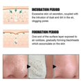 thumbnail image 3 of Mascarilla para eliminar puntos negros que limpia los poros de forma suave y profunda para succionarlos -7354371456373, 3 of 5