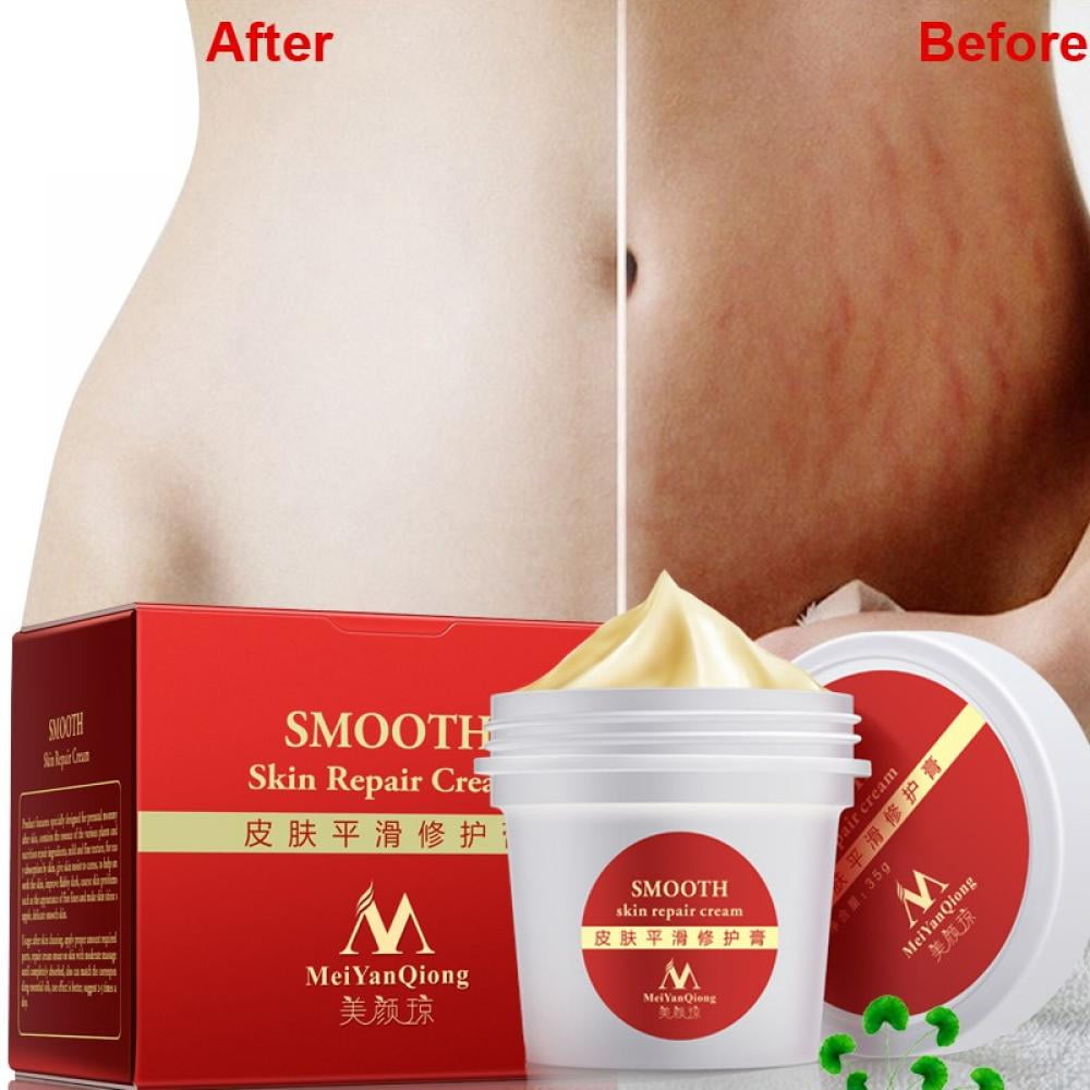 Stretch Mark Removal Cream Repair Scars Stretch Marks Remove Pregnancy Scar Cream