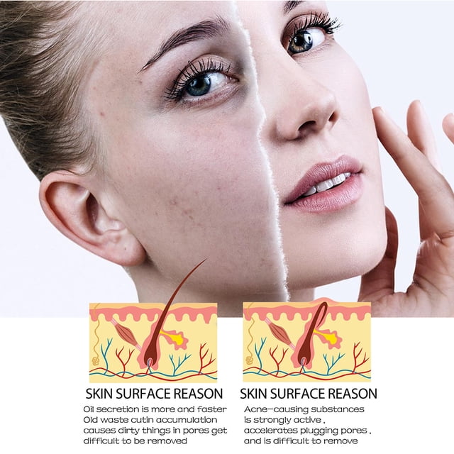 Suero facial de 30ml ácido salicílico hidratante esencia nutritiva para la piel productos de belleza JShteea Cuidado Belleza