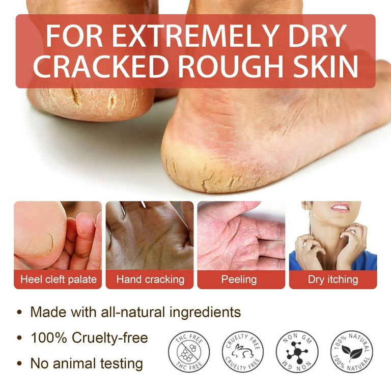 Feet really dry shop and cracking