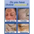thumbnail image 5 of Crema blanqueadora antipecas, ilumina el tono de la piel, elimina las pecas, aclara las manchas, ilumina el Chloasma, hidrata el cuidado de la piel facial, 5 of 5