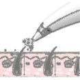 thumbnail image 2 of Visual Blackhead Pore Cleaner, Electric Blackhead Suction And Pore Cleaner, 2 of 5