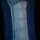 thumbnail image 5 of 2x300ml Adultos Enjuague Nasal Lavar La Limpiar Irrigador Pot Bottle Azul Yuyangstore Juego de botella de enjuague nasal, 5 of 8