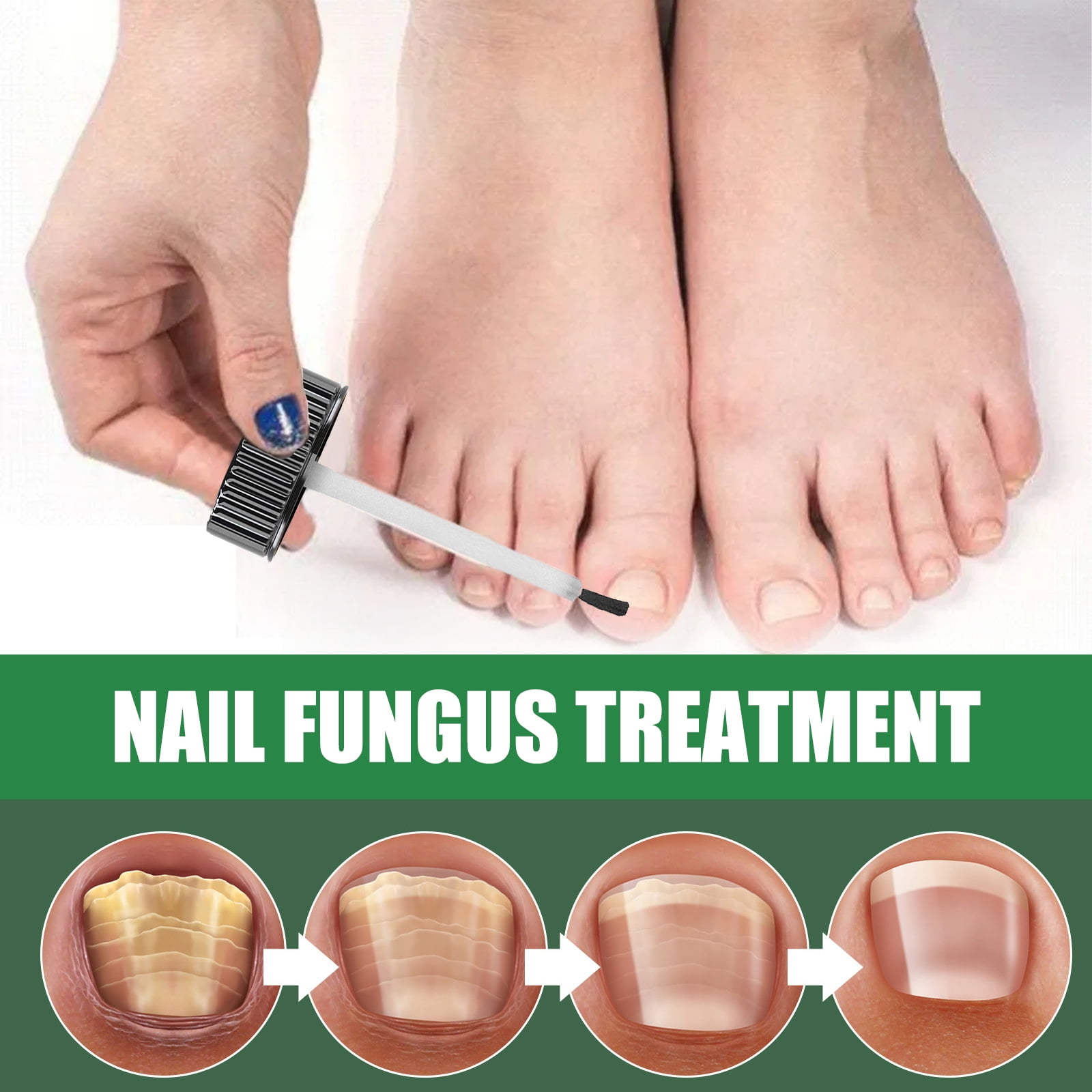 Supremely Nail Fungal Treatment for Toenails Extra Strong, Nail Fungus  Treatment | Best Nail Care and Nail Repair Treatment | Tea Tree Oil, Sweet Almond  Oil, & Jojoba Oil (Pump) (100ML) :