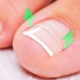 thumbnail image 2 of Kit de corrección de uñas encarnadas, tratamiento para uñas, parche para alisar uñas, empujador, herramienta de recuperación, kit para el cuidado de los pies, 2 of 9