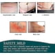 thumbnail image 3 of Silicone Plasters For Scars, Silicone Scar Films For Surgeries, Caesarean Section, Keloids, Burns,silicone Scar Tape-4cm*3m, 3 of 5