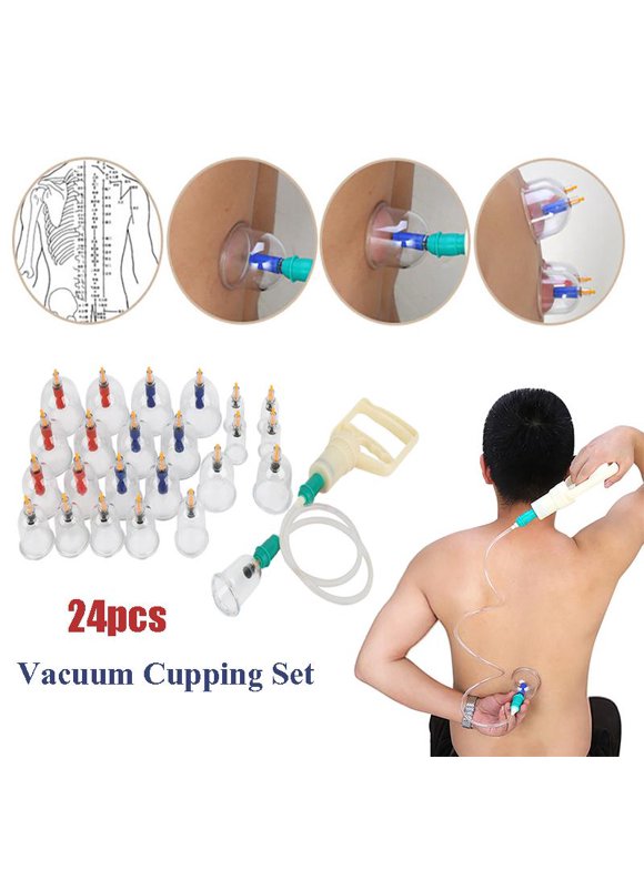 Cupping Therapy in Massage