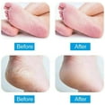 thumbnail image 4 of Electric Callus Remover, Usb Rechargeable Callus Remover, White, 4 of 6
