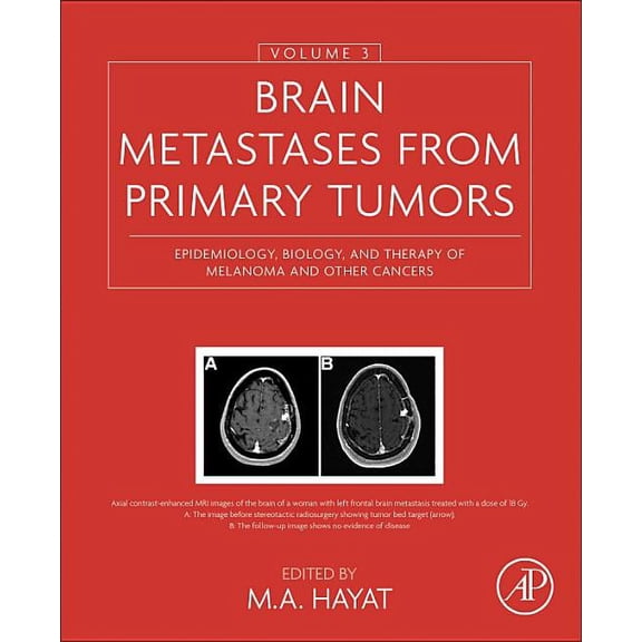 Brain Metastases from Primary Tumors, Volume 3: Epidemiology, Biology, and Therapy of Melanoma and Other Cancers, (Hardcover)