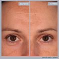 thumbnail image 3 of Almohadillas rejuvenecedoras SKINN Multi-Acid con glicólico, láctico y salicílico, 3 of 6