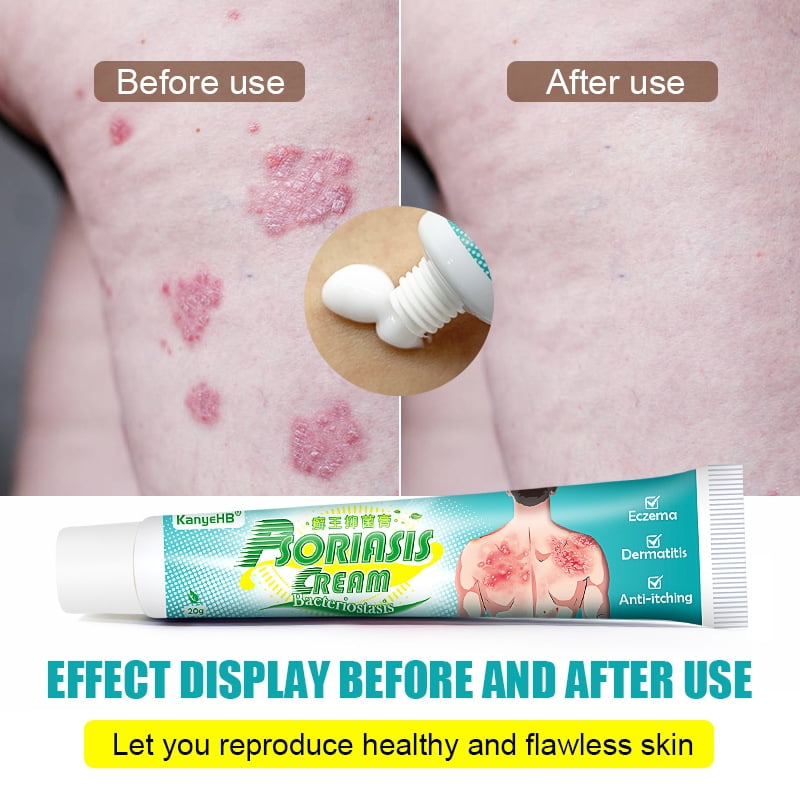 Psoriasis Itch Relief Cream Ointment Fungus Targeted Treatment Essence 20g
