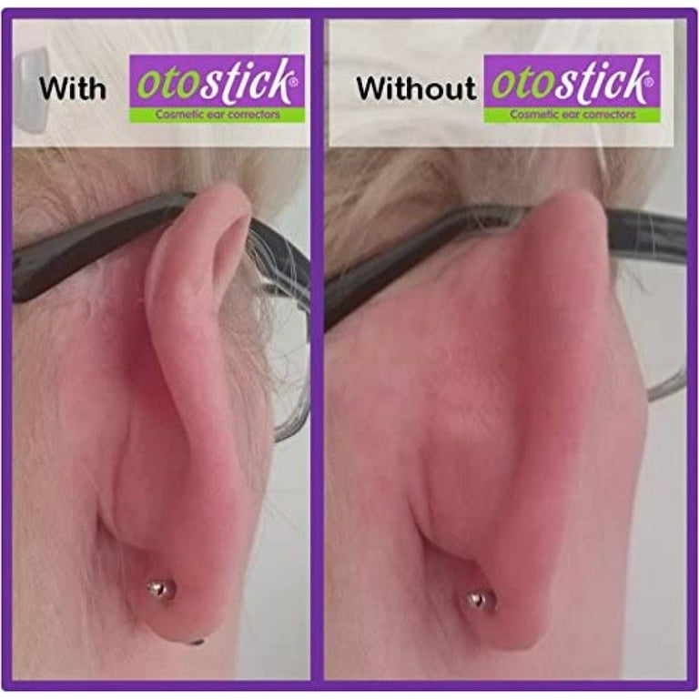 otostick - Otostick PROMINENT EAR Corrector is as easy as 1,2,3! Proper  placement is a must to ensure your ear corrector works efficiently. # otostick #earcorrection #earcorrector #earcorrectionwithoutsurgery