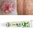 thumbnail image 3 of Crema Medicinal ZUDAIFU de 15g con Fórmula Exclusiva para Tratar Hongos, Psoriasis, Eczema y Problemas de Piel, 3 of 7