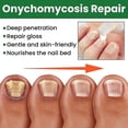 thumbnail image 3 of Essential Oil Nail Fungus Repair Liquid Nail Thickening Discoloration Off Soft Nail Thickening Type Onychomyc 20ml, 3 of 5