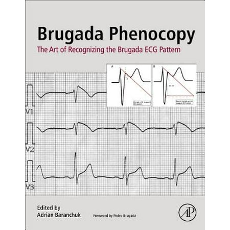 Brugada Phenocopy The Art Of Recognizing The Brugada ECG Pattern Mesmerizing Ecg Pattern Brugada Phenocopy The Art Of Recognizing The Brugada ECG Pattern Mesmerizing Ecg Pattern