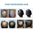 thumbnail image 2 of Spray para el crecimiento del cabello Forchics Men Advanced Solution, 100 ml, 2 of 6