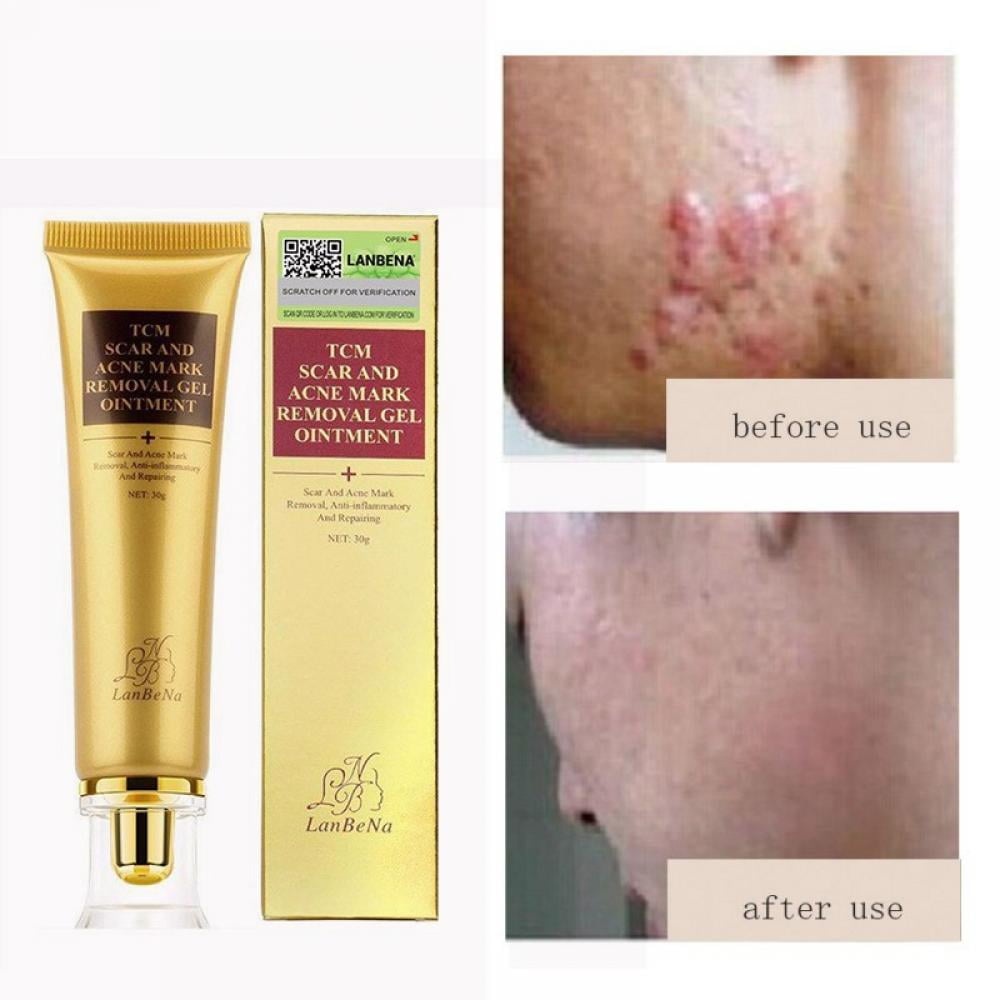 Buy 30g Scar Acnes Keloid Repairs Stretch Gel Cream Marks Skin Burns