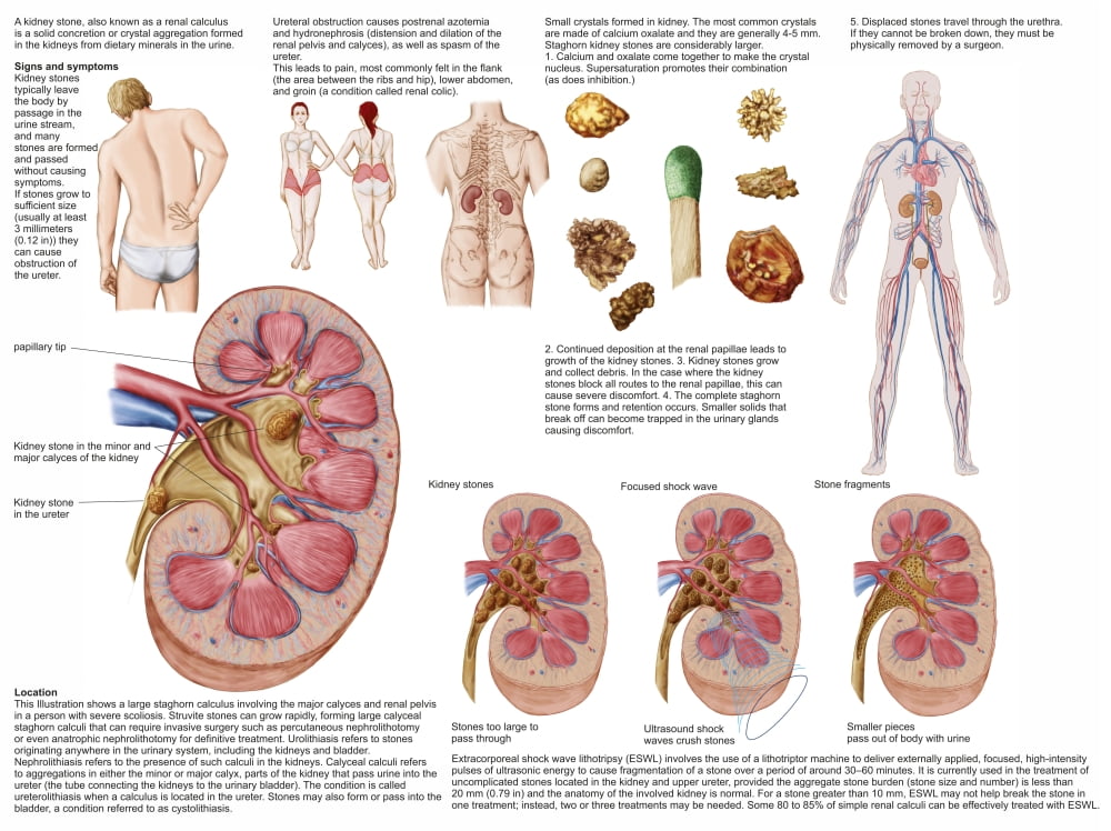 Medical chart showing the signs and symptoms of kidney stones Rolled
