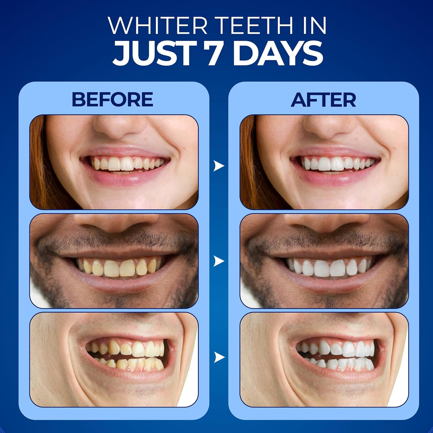 Euphauria Teeth Whitening Kit with LED Light, At-Home Sensitive Teeth Whitener, Red and Blue UV Whitening Spectrum