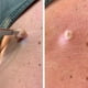 thumbnail image 4 of Removedor De Verrugas Aceite de eliminación de verrugas líquido de suero de eliminación de manchas oscuras de 20ml portátil para tratamiento facial Tmvgtek Cuidado Belleza, 4 of 9