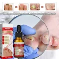 thumbnail image 2 of Hongo de uñas Extra fuerte para pies, cuidado de reparación de uñas, eliminación de hongos para dedos de los pies, antiinfección, nuevo, 2 of 5