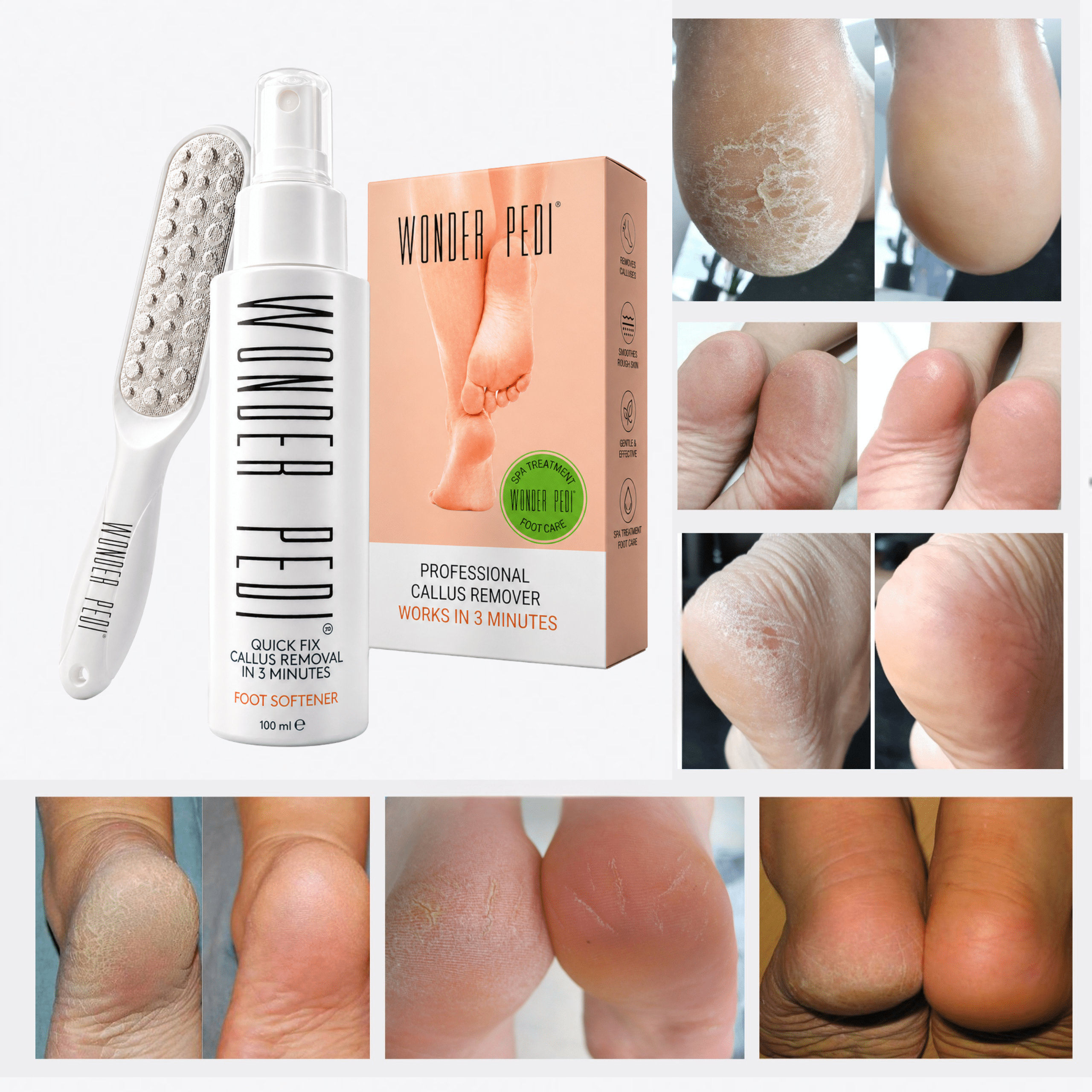 Callus Remover - Three Minutes Quick Fix- Foot File Rasp - Instant Foot Exfoliating Softener Peel Spray, Heels Callus Scrubber File - Home Spa Pedicure Treatment. Wonder Pedi
