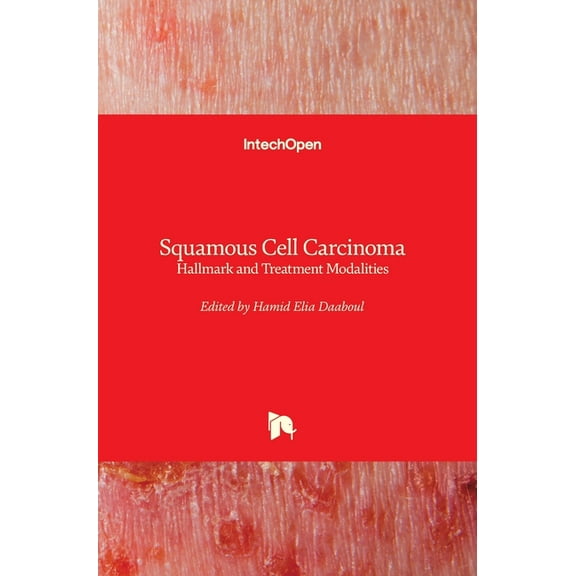 Squamous Cell Carcinoma: Hallmark and Treatment Modalities (Hardcover)