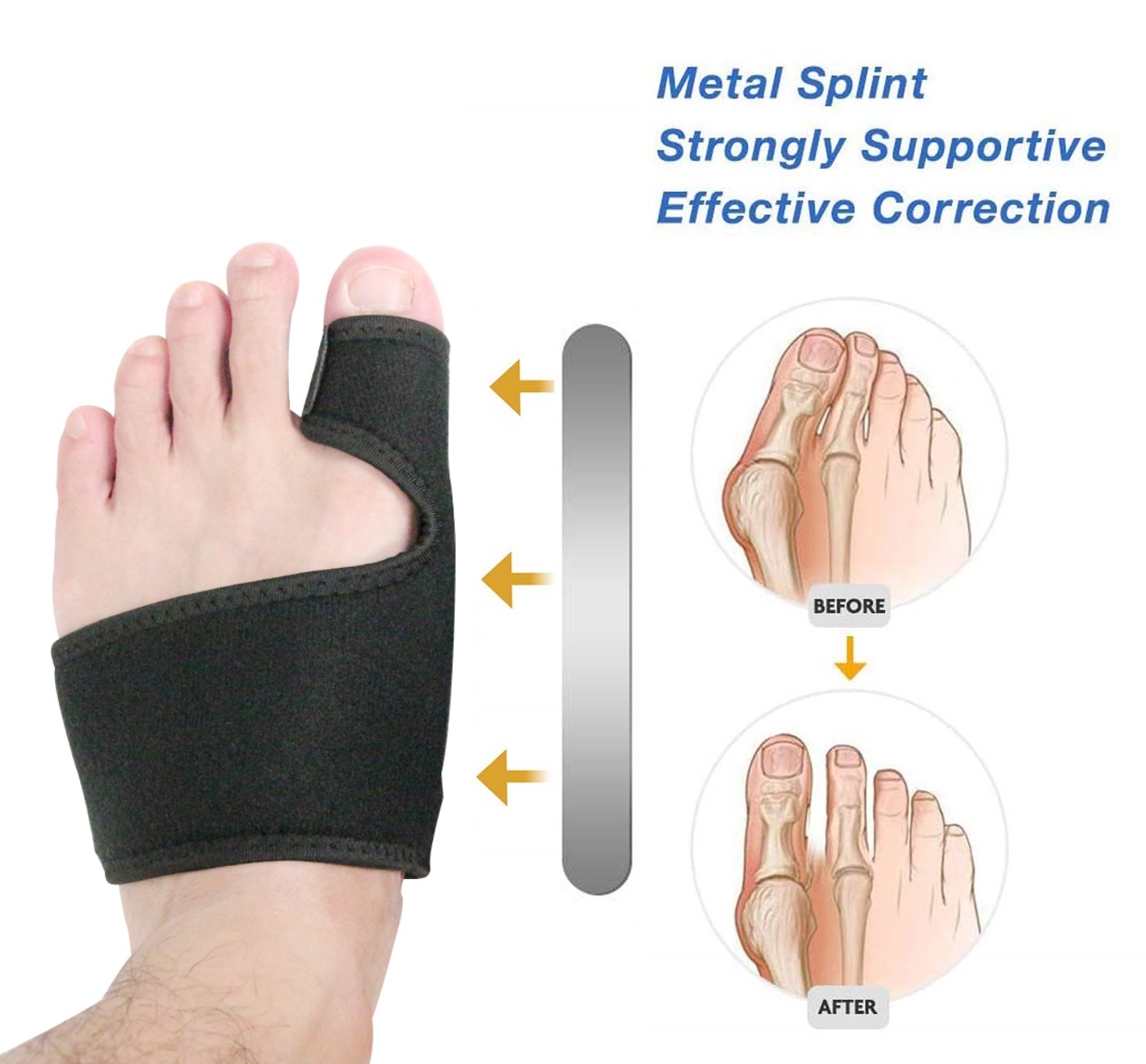 Bunion Splint Before And After Pictures Outlet USA boys.velvet.jp
