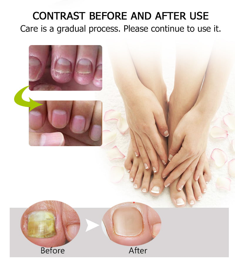 Nail Repair Gel Toenail Fungus Treatment Gel Restore Brittle Yellow Nails  For Damaged Nails New | Nail Repair Gel Toenail Fungus Treatment Gel  Restore Brittle Yellow Nails For Damaged Nails 