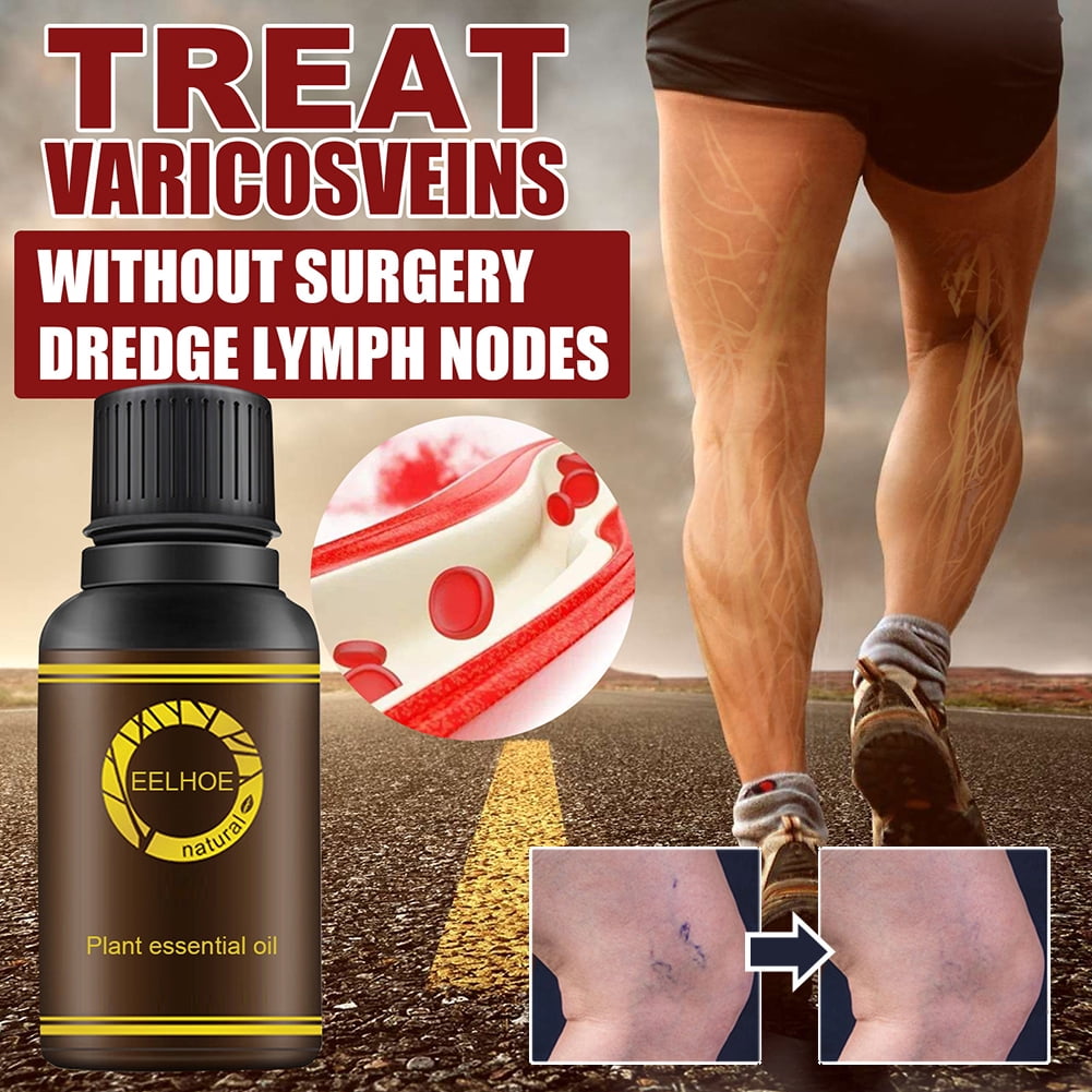 Varicose Veins Essence Oils For Inflammation Blood Vase & Vasculitis