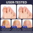 thumbnail image 3 of Antifungal Nail Treatment Pen(10PCS), Extra Strength Toenail Fungus Treatment for Toenails & Fingernails, 3 of 8
