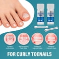 thumbnail image 2 of Ingrown Toenail Treatment, Ingrown Toenail Corrector Patch, Titanium Alloy Ingrown Toenail Care Kit for Curly Nail Support, 2 of 8