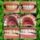thumbnail image 3 of Polvo dental mineral para restauración dental 50 g/50 ml - ginolmis, 3 of 7