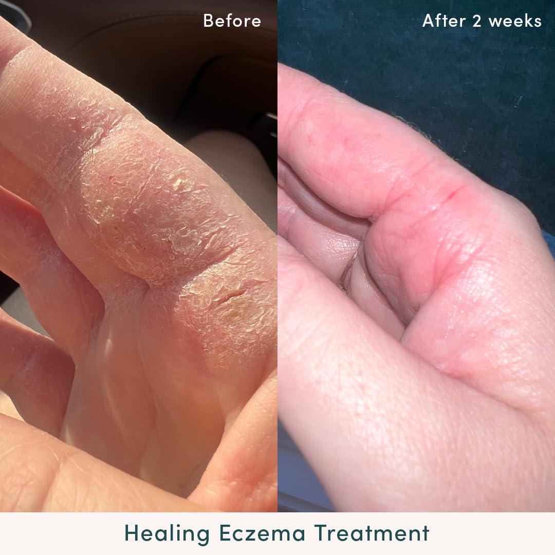 Evereden Healing Eczema Treatment, 1.7 fl oz | Safe & Efficient Eczema Cream | Gentle & Fragrance Free Eczema Cream for Babies, Kids, and Adults