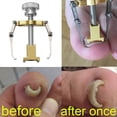 thumbnail image 4 of Professional Ingrown Toenail Correcter Stainless Steel Ingrown Toenails Lifter Treatment Pedicure Tool Nail Care Tool, 4 of 4