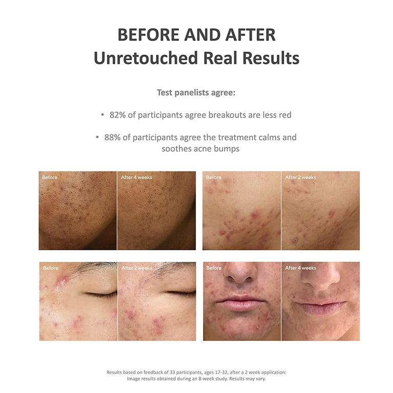 Deep Relief Acne Treatment Acne Control by Murad