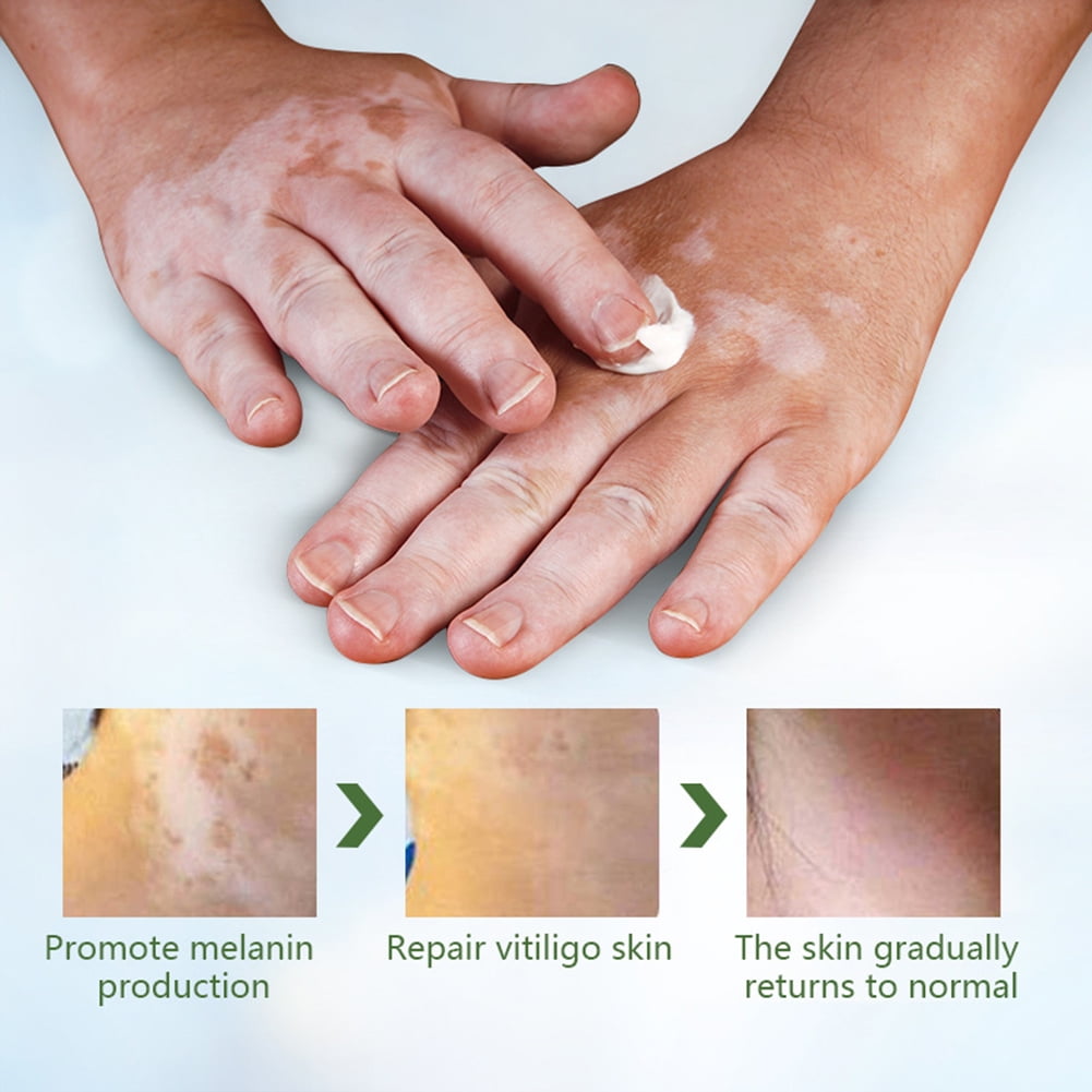 Buy Kitsin Vitiligo Cream, Vitiligo Cream for Skin Vitiligo, Vitiligo