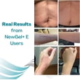 thumbnail image 6 of NewGel+ by MyNewGel Silicone Scar Gel with Vitamin E, Reduce & Fade Scars, 1 oz, 6 of 10