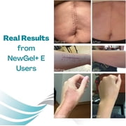 NewGel+ by MyNewGel Silicone Scar Gel with Vitamin E, Reduce & Fade Scars, 1 oz