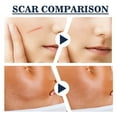 thumbnail image 1 of Silicone Scar Gel Silicone Scar Removal Treatment Stretch Mark Scar Gel Scar Gel 2PCS Scar Cream Gel Reduce Swelling Soften Skin Transparent  Silicone Stretch Mark Scar Removal, 1 of 8