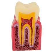 Axis Scientific Decayed Teeth Comparison Anatomy Model, 6x Life-Size, Human anatomy system miniature, demonstration skill, educational model Includes Product Manual, scientific anatomy model