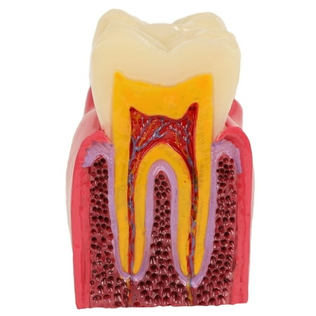 Axis Scientific Decayed Teeth Comparison Anatomy Model, 6x Life-Size, Human anatomy system miniature, demonstration skill, educational model Includes Product Manual, scientific anatomy model