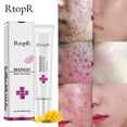 thumbnail image 2 of Limited time offer! Acne Extract Acne Removal Marks Facial, 2 of 9