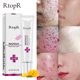 thumbnail image 2 of Acne Extract Acne Removal Marks Facial, 2 of 5