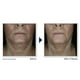 thumbnail image 3 of Crema para el cuello RoC Derm Correxion con ácido hialurónico y retinol 50 ml, 3 of 7