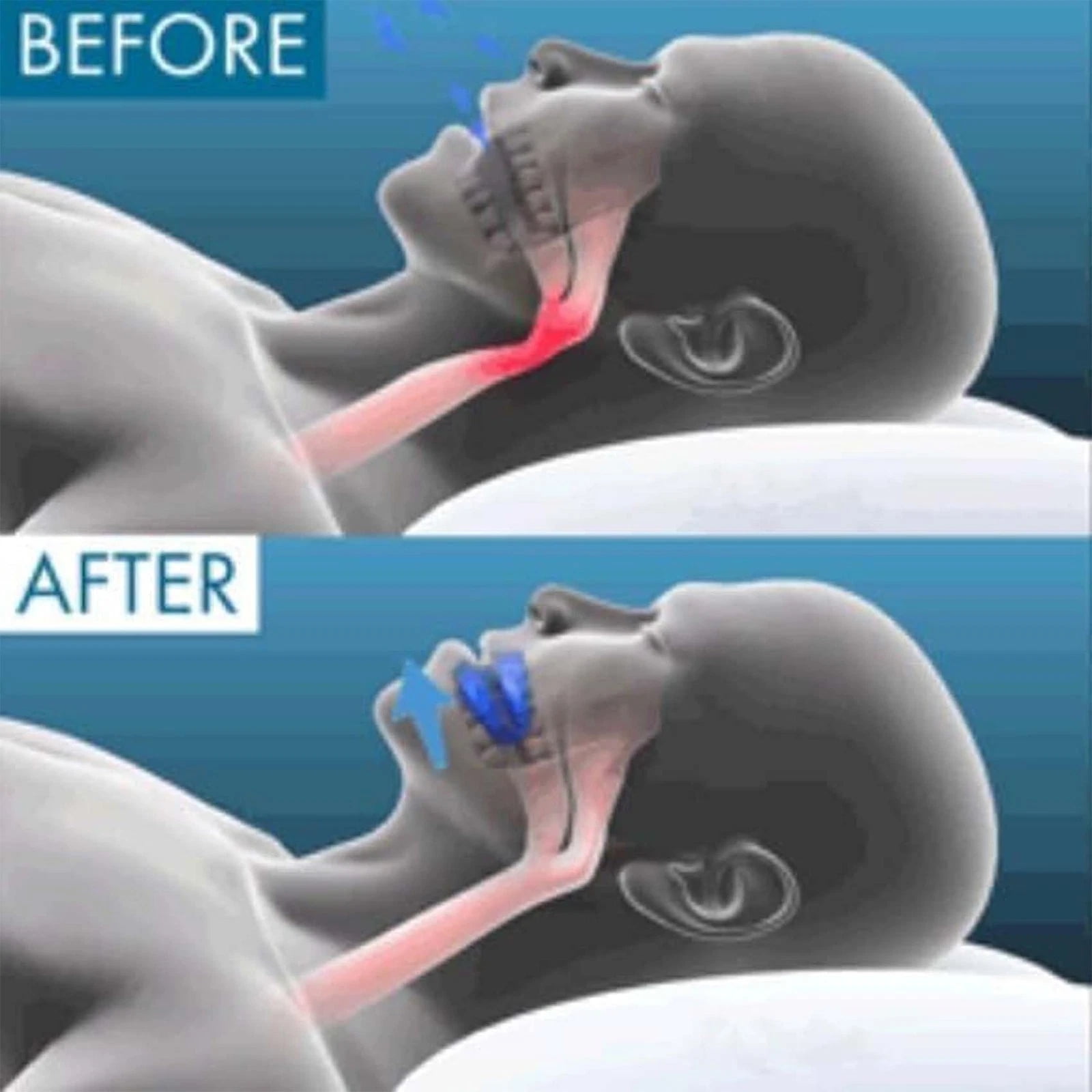 Anti Snoring Mouthpieces Reduce Snoring Aid for Comfort, Easy Breathing,4PC
