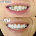 thumbnail image 2 of Dos juegos de dentaduras postizas, prótesis de mandíbula superior e inferior, naturales y cómodas, protegen los dientes y restauran una sonrisa segura., 2 of 5