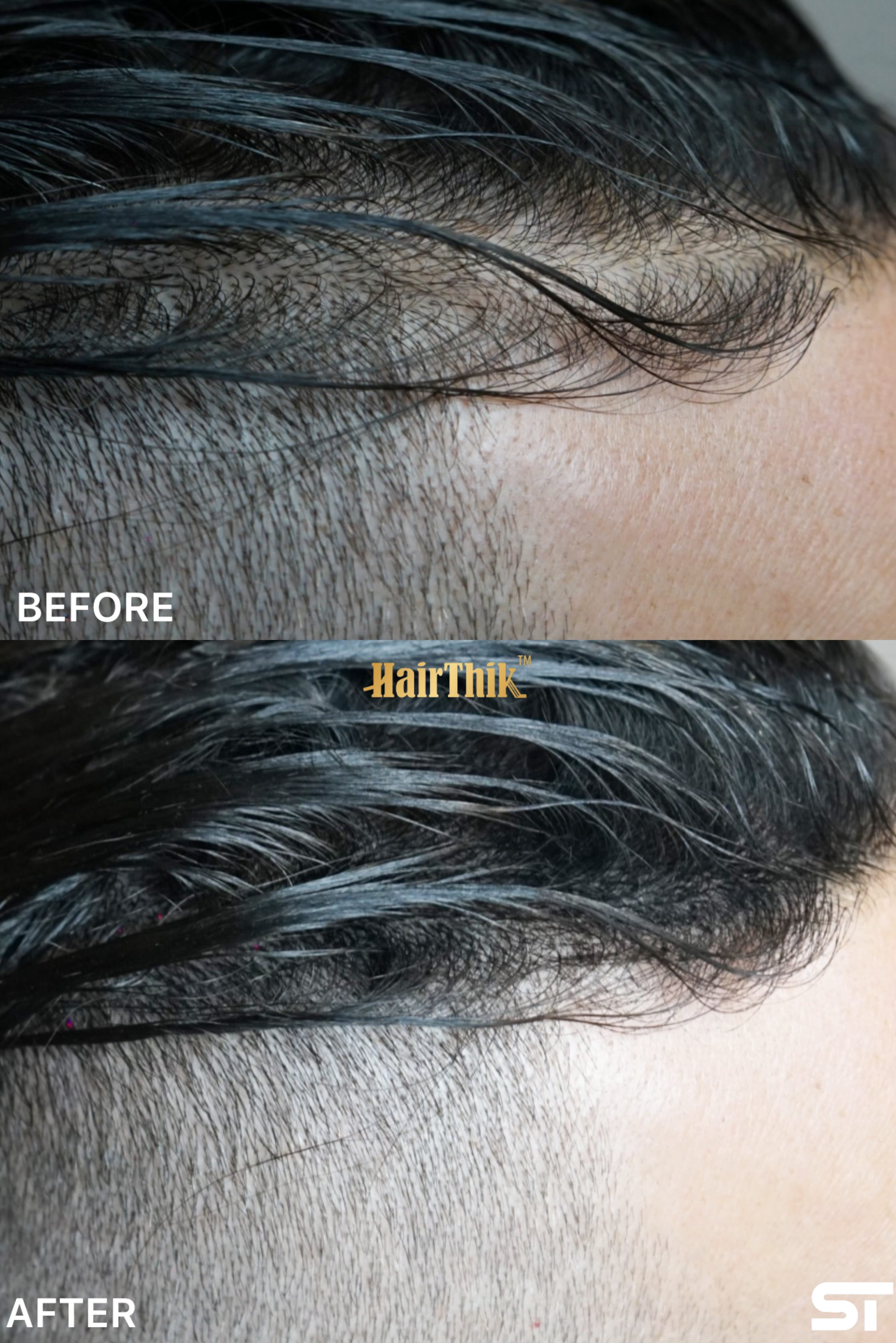 HairThik Hair Building Fibers - Instantly Fill in Fine or Thinning Hair for Thicker, Fuller-Looking Hair for Men & Women – Hair Thinning & Balding solution | DARK BROWN, 25 Grams - HFR/25DB