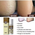 thumbnail image 5 of 3pcs Anti Fungal Infections Fungus Combat Feet Spray Athlete's Foot Spray, 5 of 5